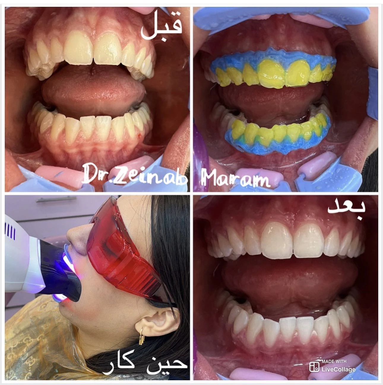 نمونه بلیچینگ دندان در رباط‌کریم