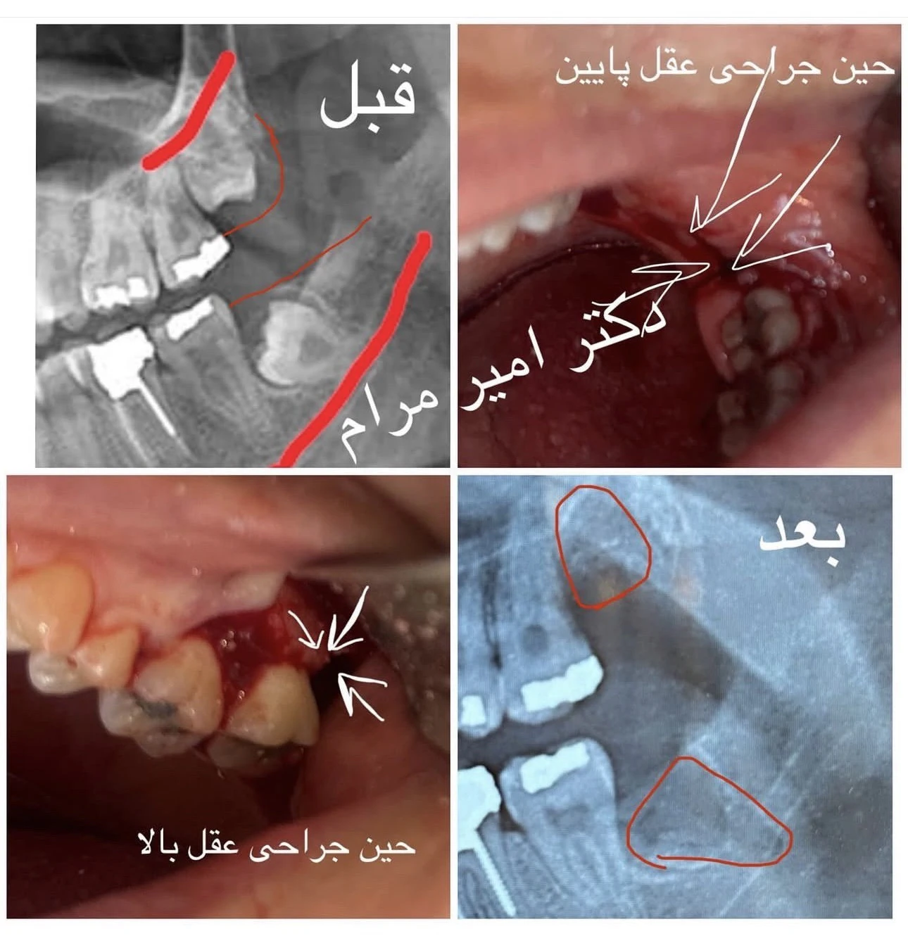 نمونه جراحی دندان عقل نهفته در رباط‌کریم