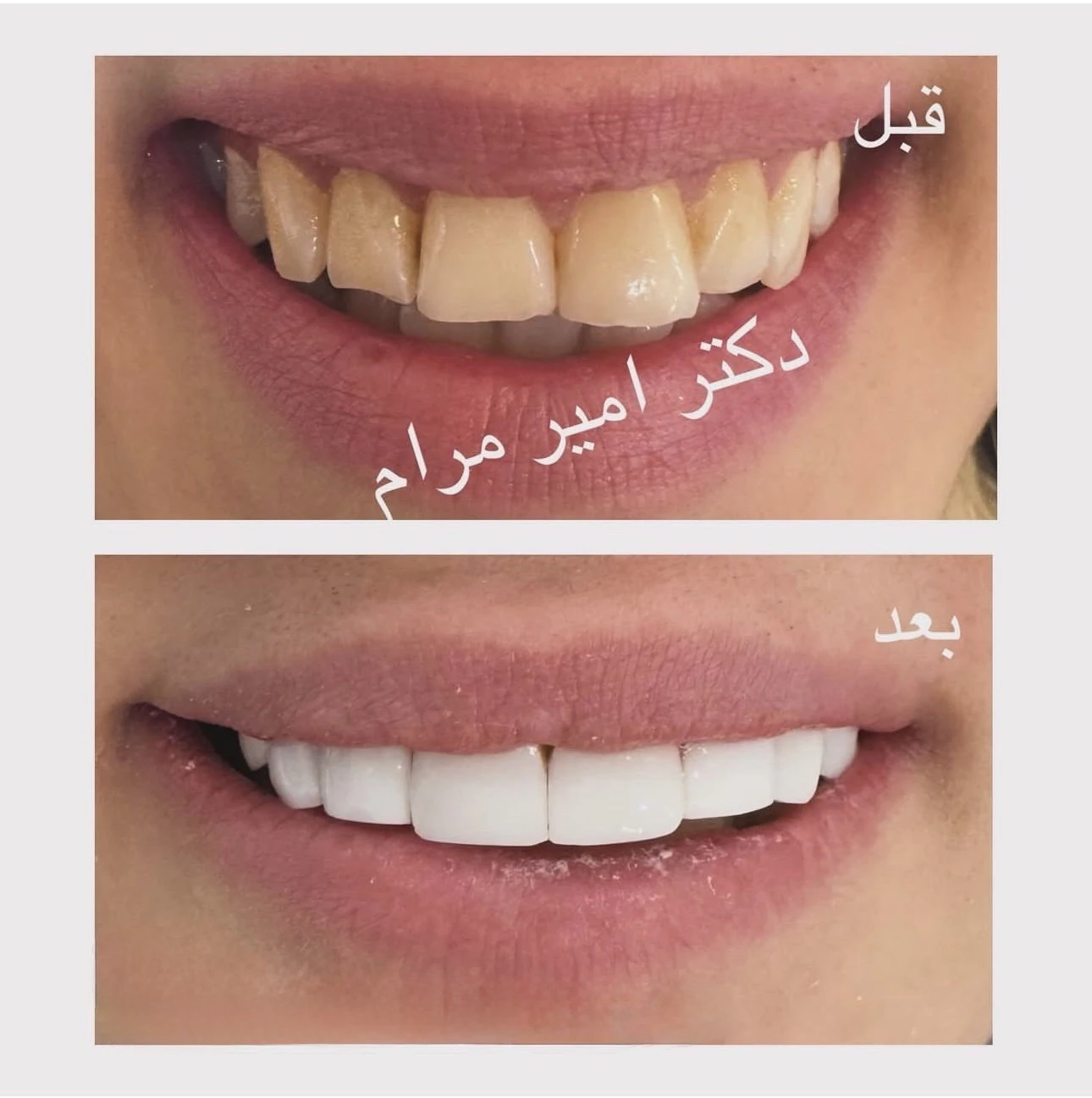 نمونه بازسازی لبخند با کامپوزیت در رباط‌کریم