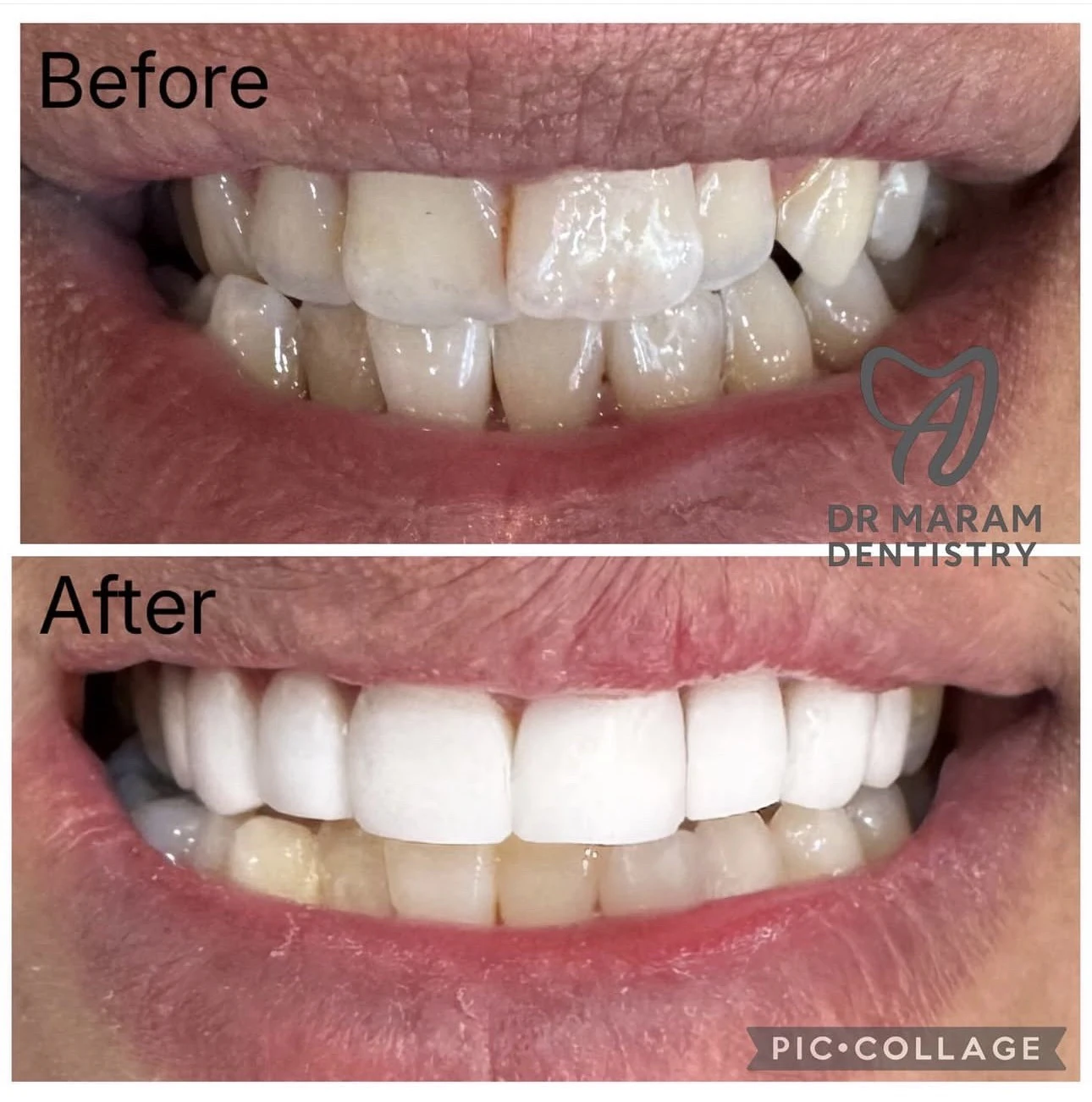 نمونه اصلاح طرح لبخند با لمینیت یا کامپوزیت