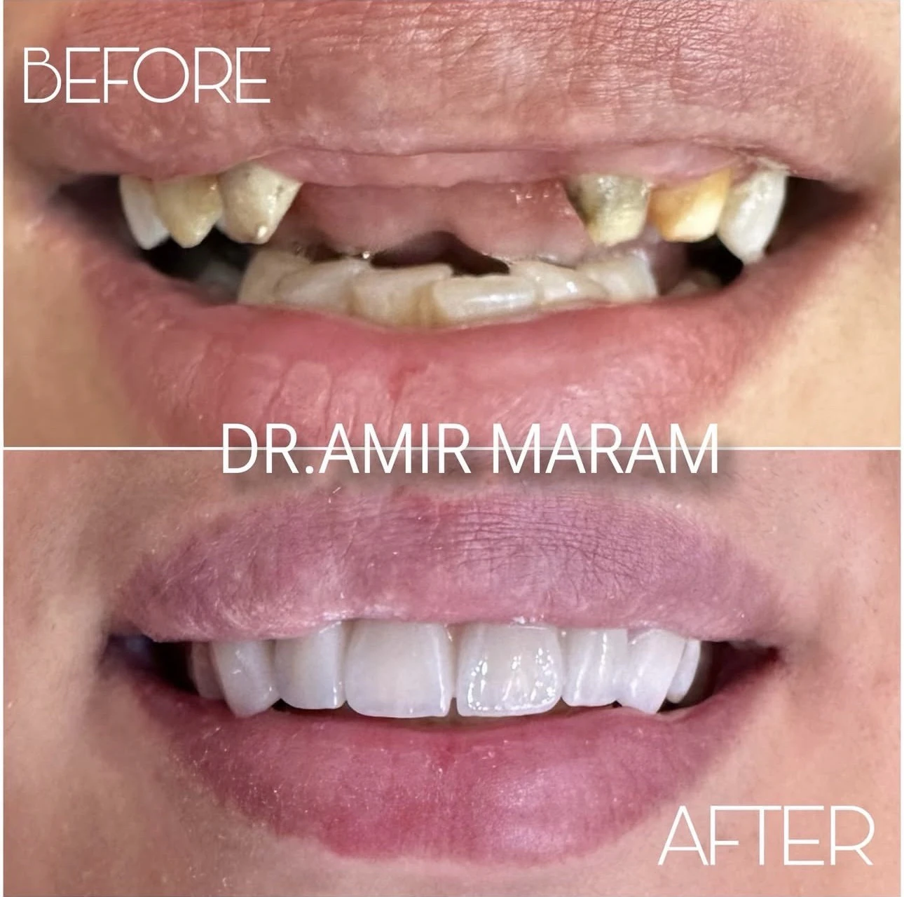 نمونه بازسازی لبخند و بلیچینگ