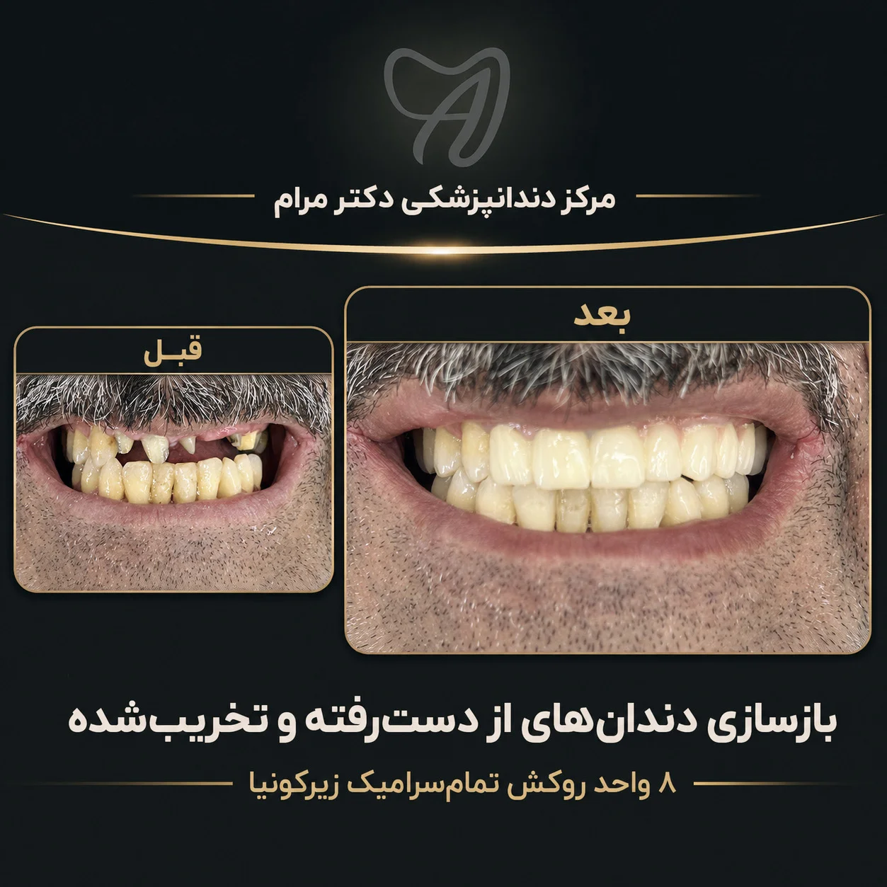 قبل و بعد از بازسازی دندان‌ها با ۸ واحد روکش زیرکونیا در مرکز دکتر مرام